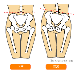 骨盤矯正
